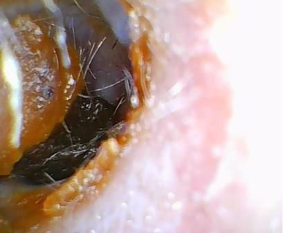 image of significant ear wax in the ear canal